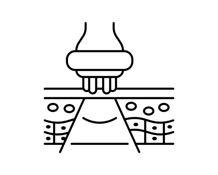 Radiofrecuencia Fraccionada