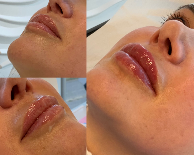 Ácido Hialurónico Relleno & Perfilado de Labios