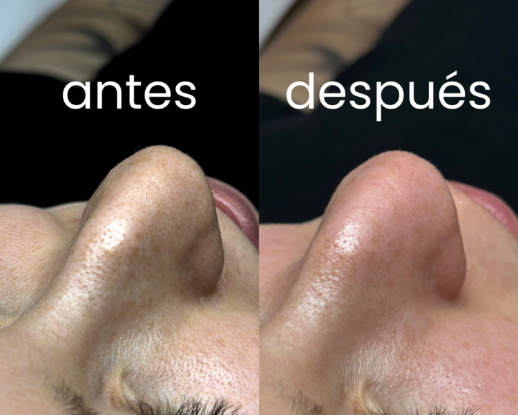 PURE RESET FACIAL — Limpieza facial profunda ⭐️