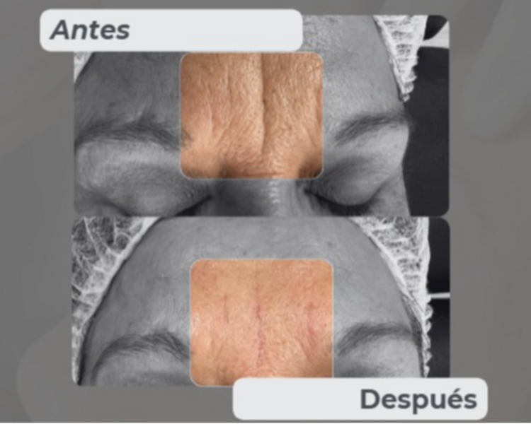 Ácido Hialurónico Arrugas Finas (Entrecejo, Marioneta, Patas de gallo)