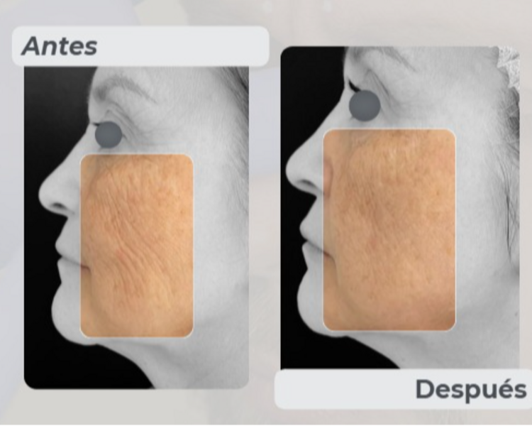 HydroxyFill - 1 Sesión