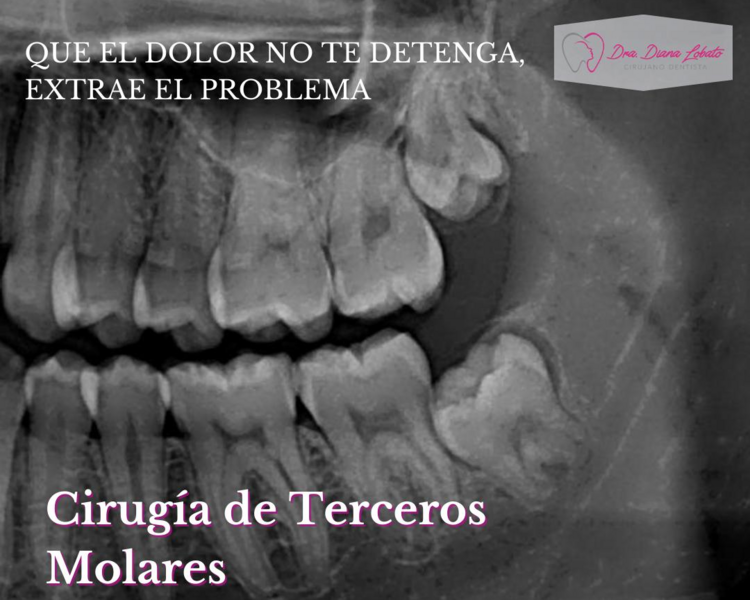Cirugía de 3eros Molares