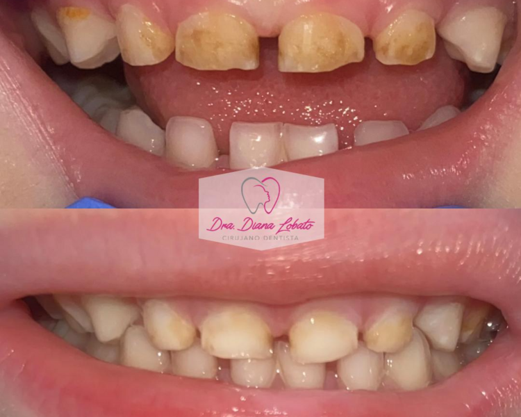 Limpieza Dental