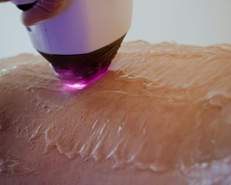 Depilación láser cuerpo completo (8 sesiones)