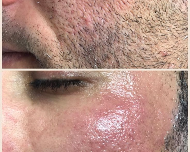 Depilación láser barba completa (8 sesiones)