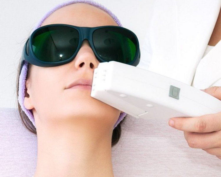 Depilación láser bigote (8 sesiones)