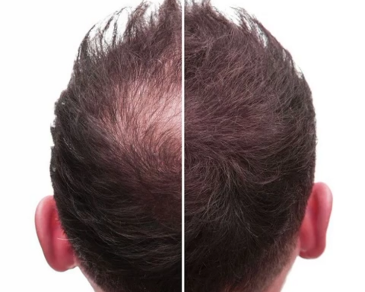 Tratamiento Capilar / 10 sesiones