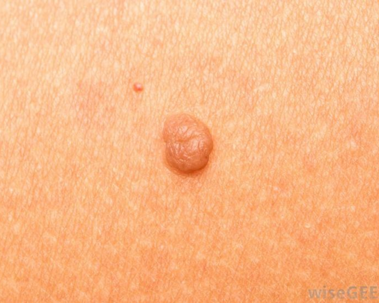 Valoración remoción de lunares