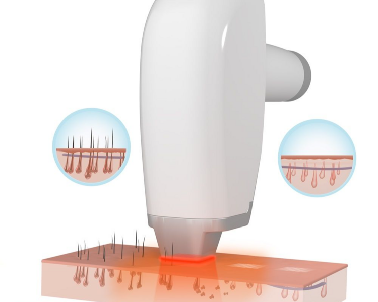 Evaluación para Depilación Láser
