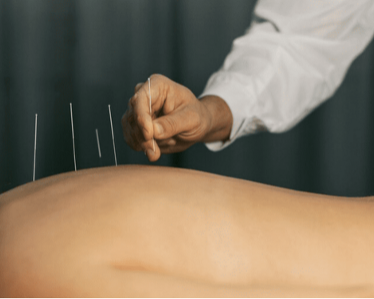 Tui Na con acupuntura