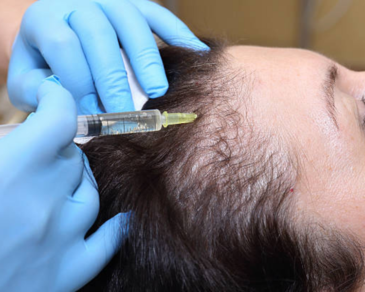 Plasma Rico en plaquetas en cuero cabelludo