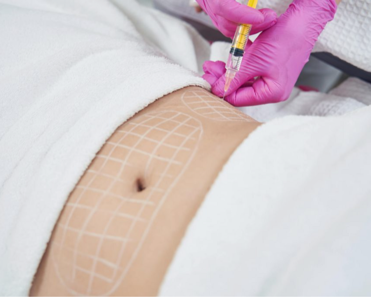 Mesoterapia Corporal - Zona abdominal