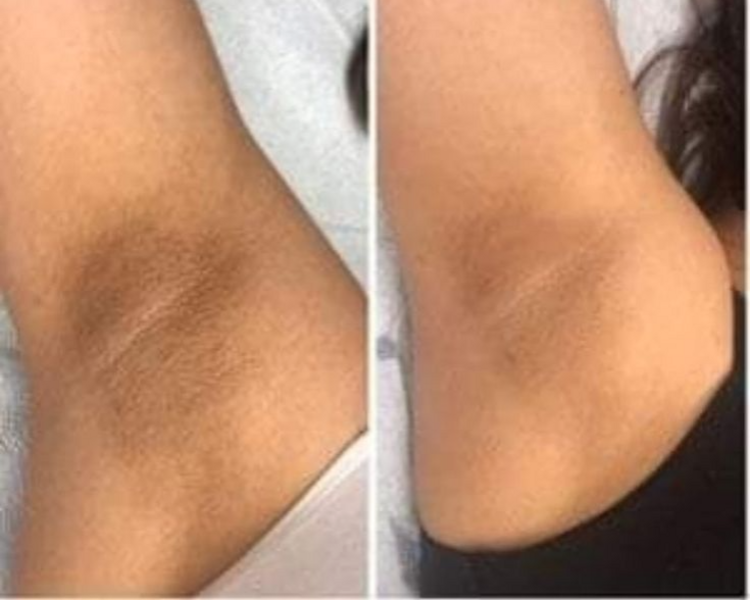 Hollywood peel en axilas