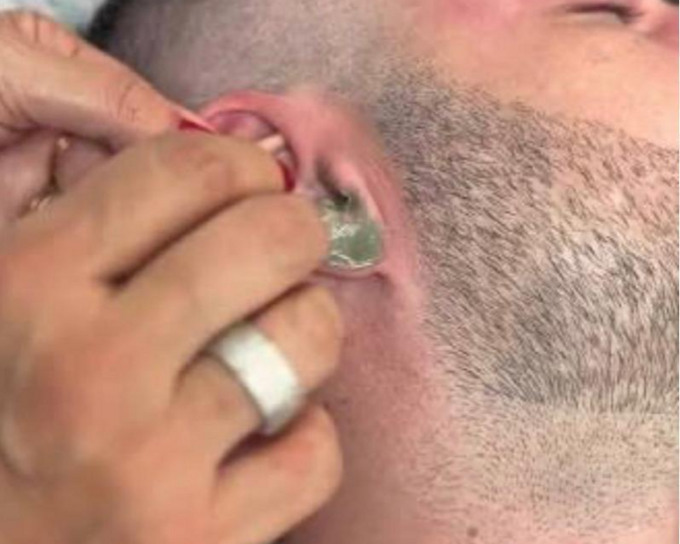 Depilación de orejas 