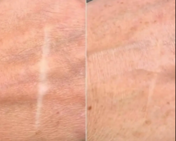 Camuflaje Cicatrices / Vitiligo / Estrías (Tamaño L)