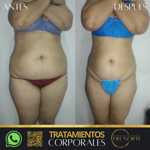 Tratamiento de TONIFICACION-MOLDEO*5