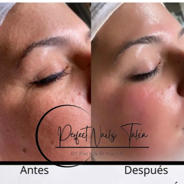 Biorevitalizacion con Ácido Hialuronico