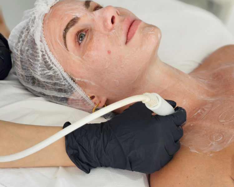 BABY FACE X 1 SESIÓN (RADIOFRECUENCIA FACIAL)