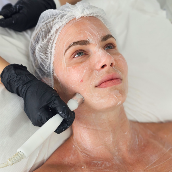 LIMPIEZA+BABY FACE+MICRONEEDLING (RADIOFRECUENCIA+DERMAPEN)(ROSTRO)