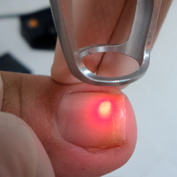 Eliminación Onicomicosis de Uña con Láser (1era Sesión)