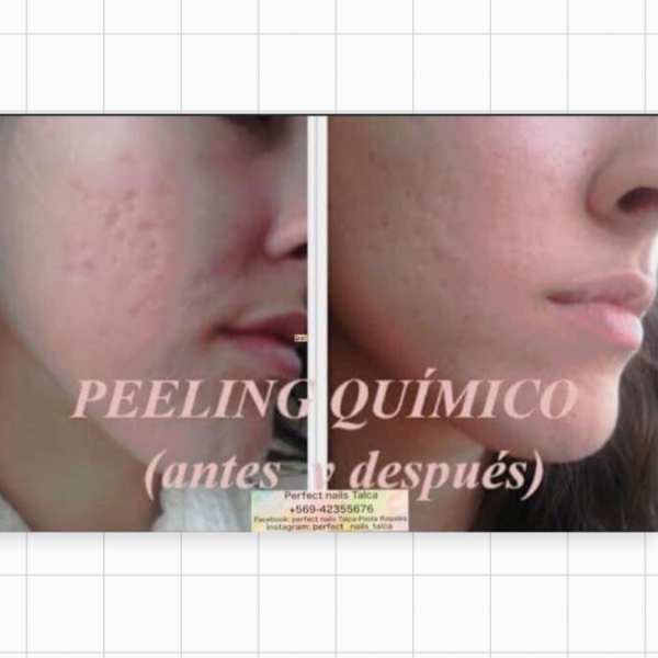 Peeling químico facial 