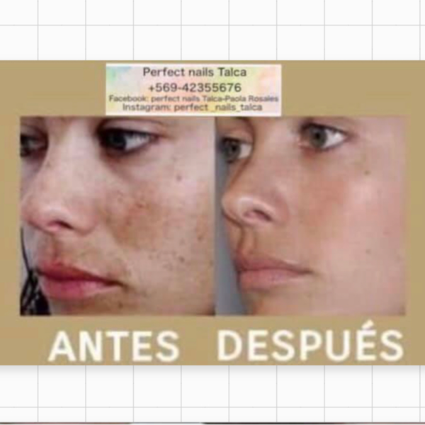 Peeling químico facial 
