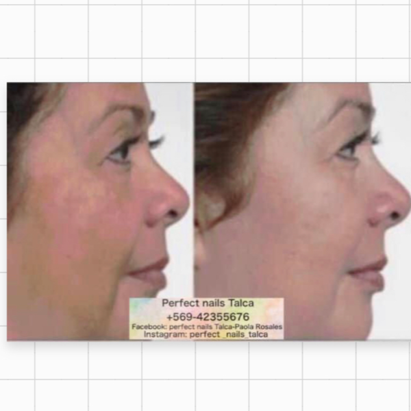 Peeling químico facial 