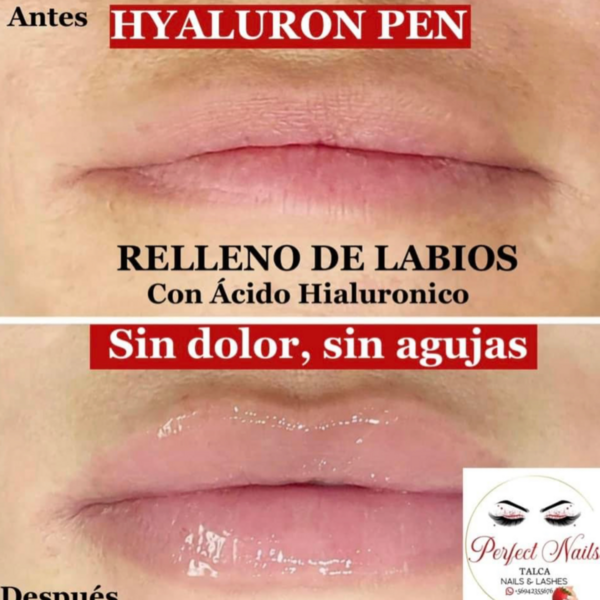 Relleno con ácido hialuronico