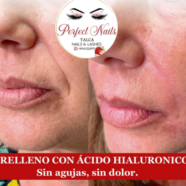 Relleno con ácido hialuronico