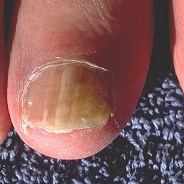 Sesión Onicomicosis (Sesiones seguimiento) x 1 uña