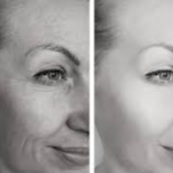 DEPAROPLASTIA SUPERIOR