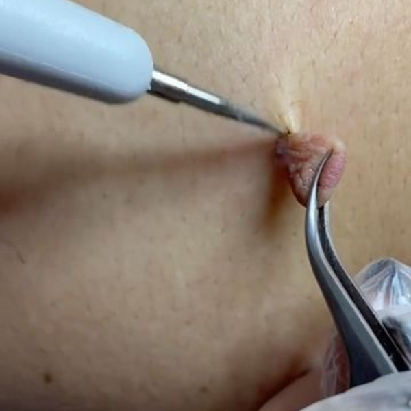 FibroBlast - Removal of Mole or Skin Tag  / FibroBlast - Eliminación de Lunares o Manchas de Piel