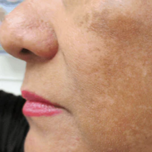 TRATAMIENTO DE MANCHAS Y PIGMENTACION 