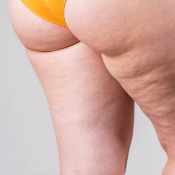 CELULITIS