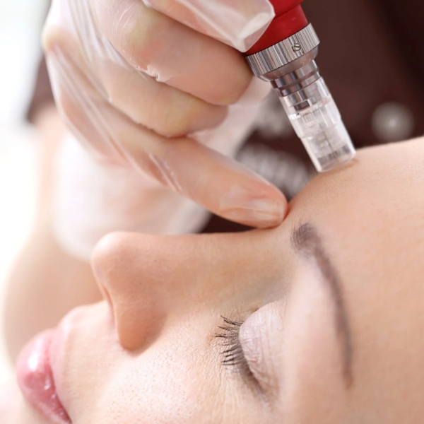 Microneedling 1 sesión / inducción de colágeno