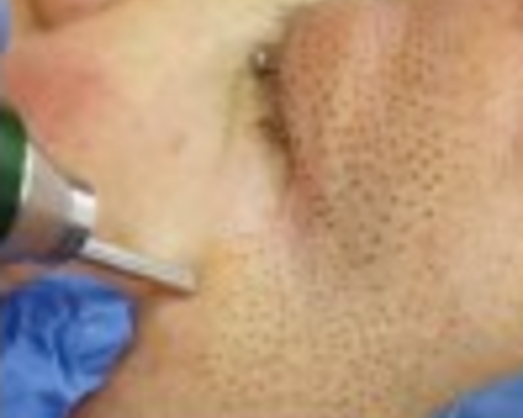 Tratamiento Facial Diamond Plasmapen Fibroblast Facial 1/2 Cara Zona Superior +45