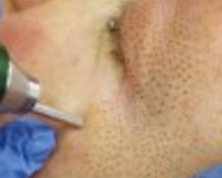 Tratamiento Facial Diamond Plasmapen Fibroblast Facial 1/2 Cara Zona Inferior
