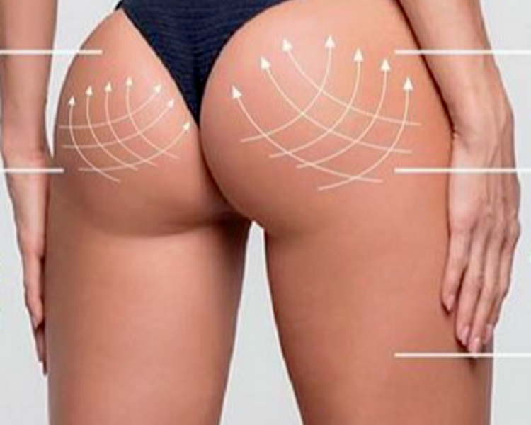 Mesoterapia Enzimática Profunda