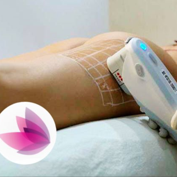 HIFU en Zonas Corporales