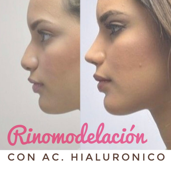 Rinomodelación con Ac Hialuronico