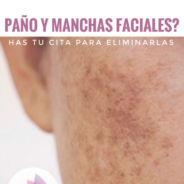 Sesion Laser para Manchas Faciales 