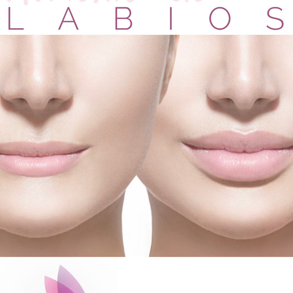 Relleno de Labios con Ac Hialurónico