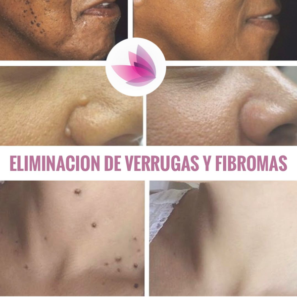 Eliminación de Lunares y Verrugas