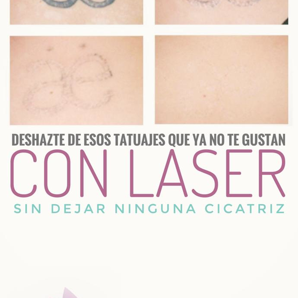 Eliminación de Tatuajes con Laser 