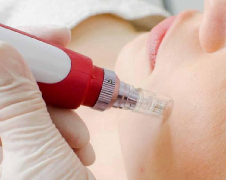 Dermapen (no incluye limpieza profunda)(EFECTIVO $36.800)