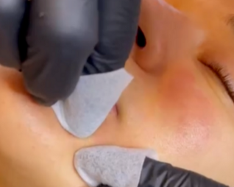 PACIENTES CON ACNE: Limpieza de cutis profunda con extracciones complejas turno con Marisel ( EFECTIVO $56.000)