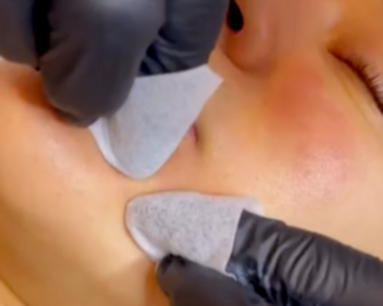 Limpieza de cutis profunda con extracciones complejas / ACNE (puntos negros y quistes de millium) ( EFECTIVO $68.000)