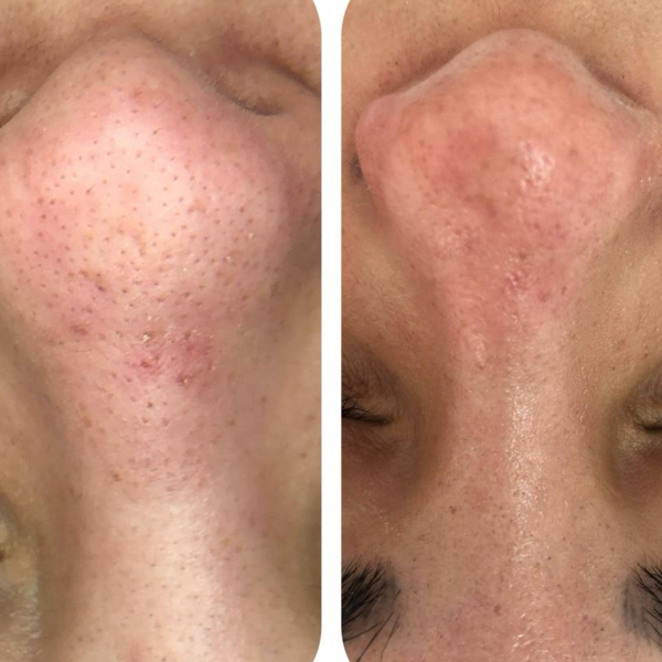 Limpieza de cutis profunda con extracciones complejas (puntos negros y quistes de millium) (EFECTIVO $53.000)