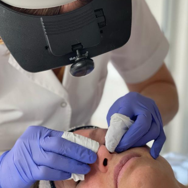 Limpieza de cutis profunda con extracciones complejas (puntos negros y quistes de millium) (EFECTIVO $53.000)