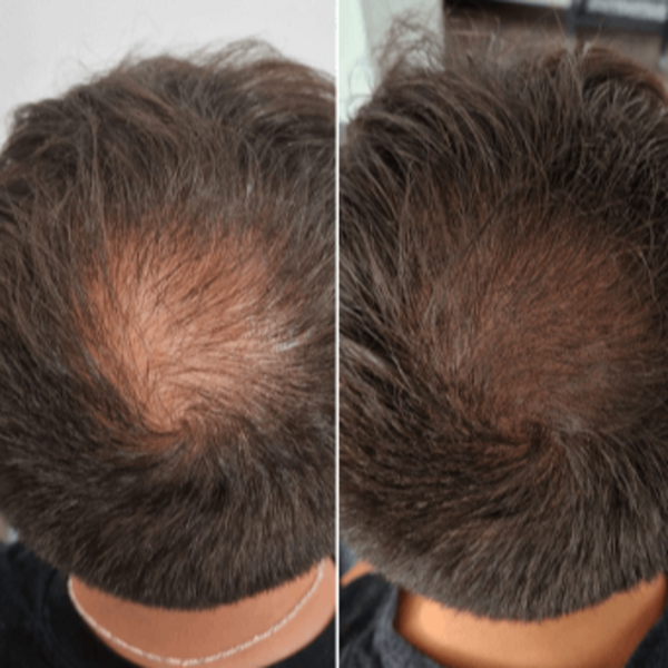 Micro Scalp Densificación Capilar 1 Zona